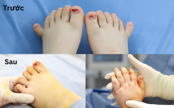 Phẫu thuật thành công cho em bé dị tật 24 ngón tay chân hiếm gặp  -0