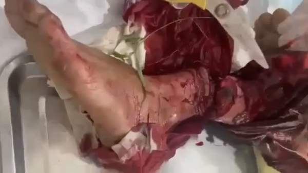 Người đàn ông bị lưỡi dao cắt gần đứt lìa cổ chân -0