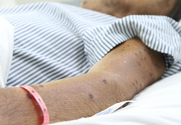 Cứu sống người đàn ông 68 tuổi ở Bạc Liêu bị ong vò vẽ đốt trên 120 vết -0