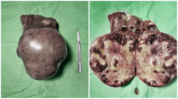 Phẫu thuật thành công cắt bỏ khối u gan khổng lồ gần 2kg cho bệnh nhân U80 -0