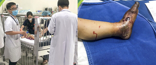 Nhiều trẻ đang ngủ bị rắn độc bò vào nhà cắn nguy kịch -0