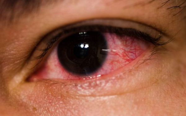 Bệnh đau mắt đỏ đang bùng phát, bác sĩ hướng dẫn cách điều trị -0