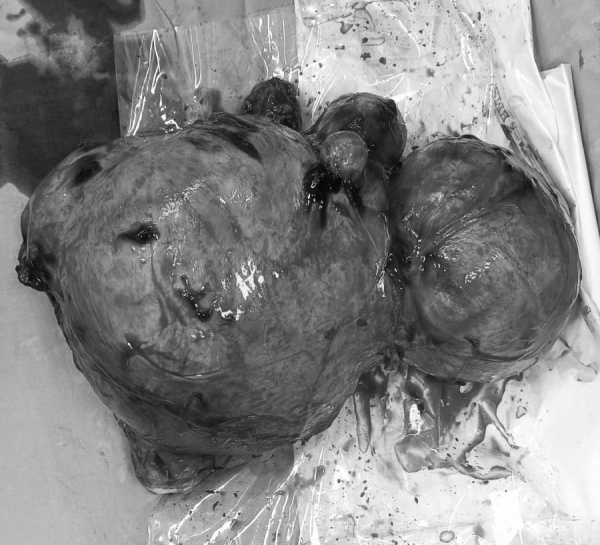 Khối u nặng 3 ký “trú ẩn” trong tử cung người phụ nữ suốt 7 năm -0