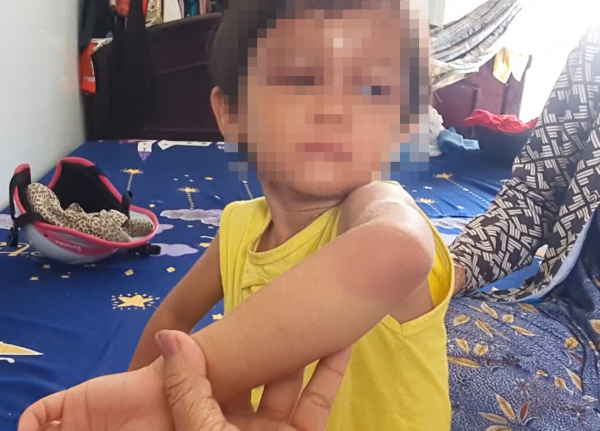 Bé gái 4 tuổi tại Cà Mau nghi bị cha nuôi đánh đập -0