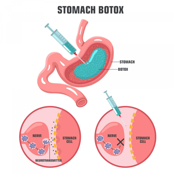 Tiêm chất độc thần kinh botox vào dạ dày làm giảm cân, chống béo phì - bằng chứng chưa thuyết phục -0