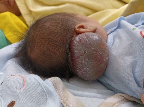 Bệnh viện Bạch Mai cứu sống cháu bé 14 ngày tuổi có khối u máu khổng lồ -0