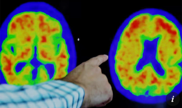 Thuốc mới mang đến hi vọng chữa bệnh Alzheimer từ năm 2024 -0