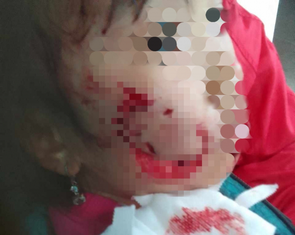 Bị chó dữ tấn công, bé gái 5 tuổi bị thương nặng ở vùng mặt -0