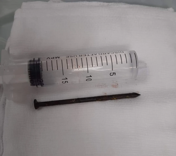 Cây đinh dài 7cm nằm trong đầu một năm trời mà bệnh nhân không biết -0