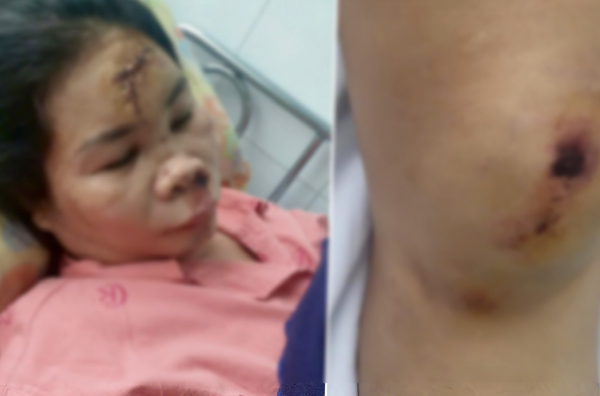 Xác minh vụ cướp giật khiến người phụ nữ bị chấn thương sọ não -0