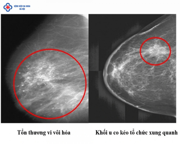 Đi chụp X-quang định kỳ: Bất ngờ phát hiện ung thư vú giai đoạn 0 – Cơ hội vàng cho sự sống -0