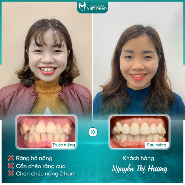 Niềng răng sai kỹ thuật - Cái giá đắt của lựa chọn sai lầm -0