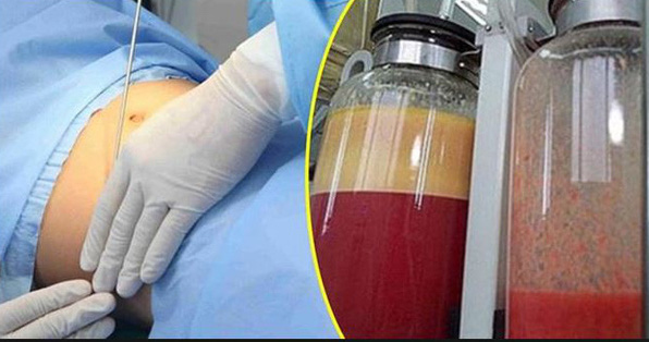 Thanh tra sở y tế TP Hồ Chí Minh vào cuộc vụ người phụ nữ 50 tuổi tử vong sau hút mỡ bụng -0
