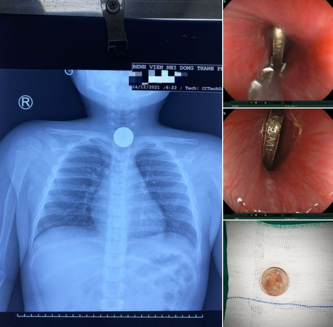 Kịp thời cấp cứu trẻ 5 tuổi nuốt đồng xu chơi game -0