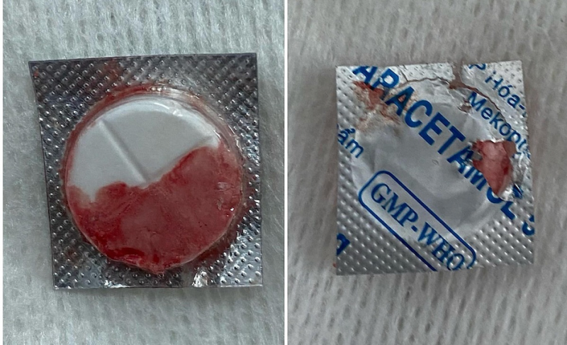 Gắp thành công viên thuốc nguyên vỏ sắc cạnh khỏi thực quản cho bé trai -0