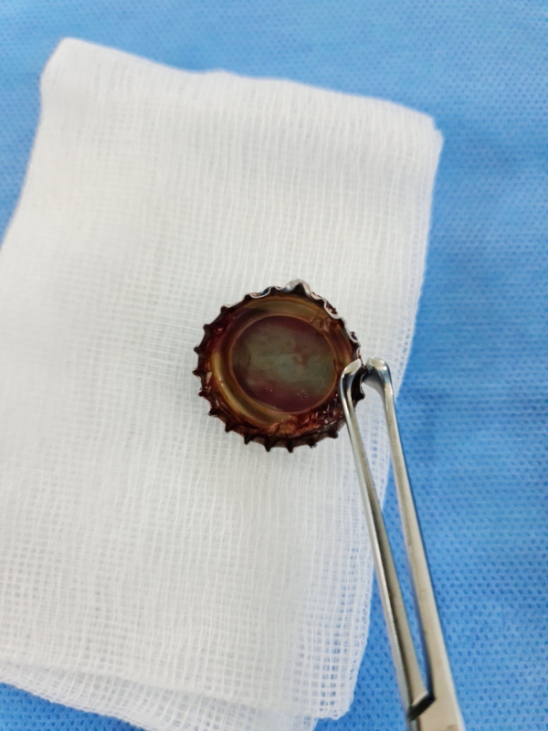 Lấy nắp chai kim loại cắm sâu hơn 2 tháng trong thực quản người bệnh  -0