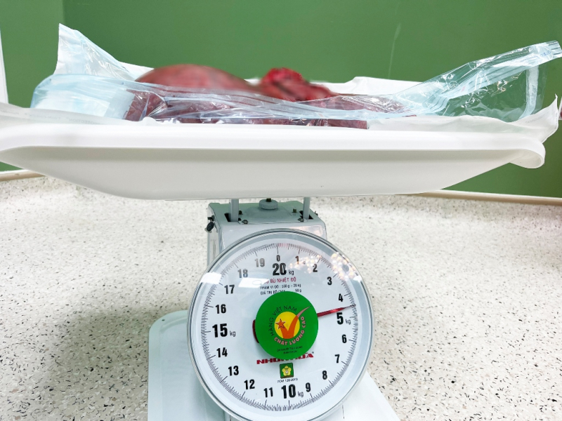 Đà Nẵng: Một phụ nữ “mang nặng” khối u xơ 4.5kg trong tử cung  -2