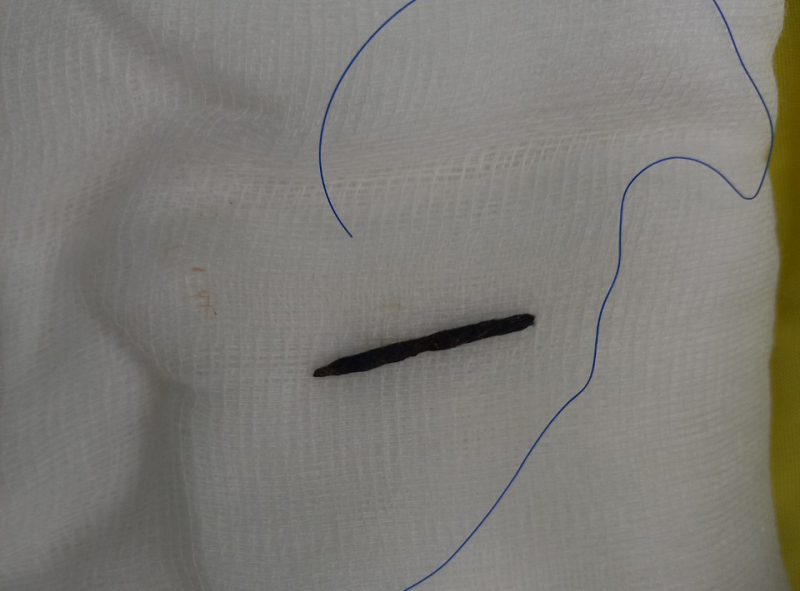 Cắt cỏ, không may bị dây thép đâm xuyên tim  -0