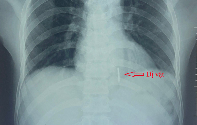 Cắt cỏ, không may bị dây thép đâm xuyên tim  -0