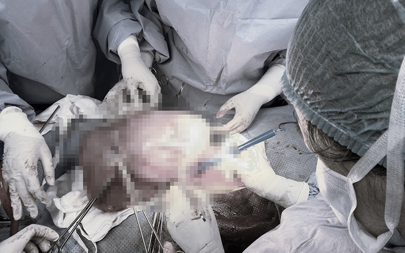 70-80% phụ nữ từ 50 tuổi trở lên có u xơ tử cung -0