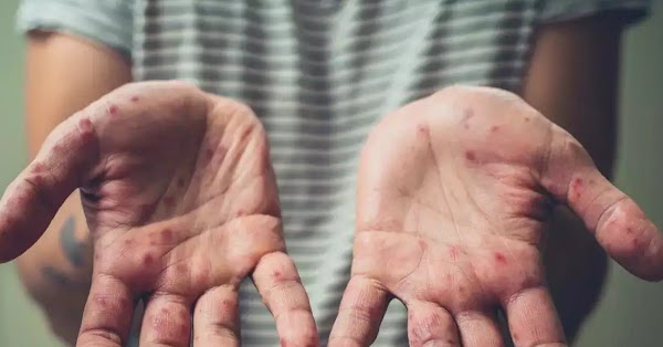 Bộ Y tế khuyến cáo 6 biện pháp phòng, chống bệnh đậu mùa khỉ -0