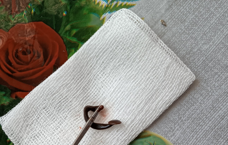 Đỉa bám sống trong mũi bé trai suốt 3 ngày -0