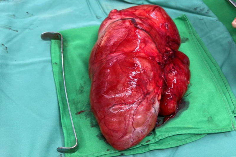           Phẫu thuật bóc tách khối u 3kg ở vùng đùi của một bệnh nhân -0
