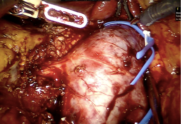 Lần đầu tiên, Bệnh viện Bình Dân dùng robot cắt ung thư thận  -0