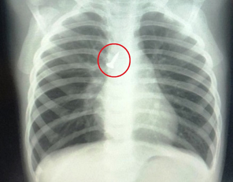Kịp thời cứu cháu bé 22 tháng tuổi bị đinh vít 1,5cm găm vào phế quản -0
