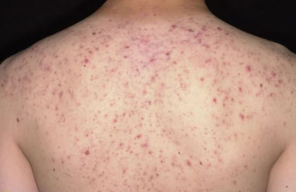 Suýt tử vong vì trị mụn trứng cá ở lưng tại một spa -0