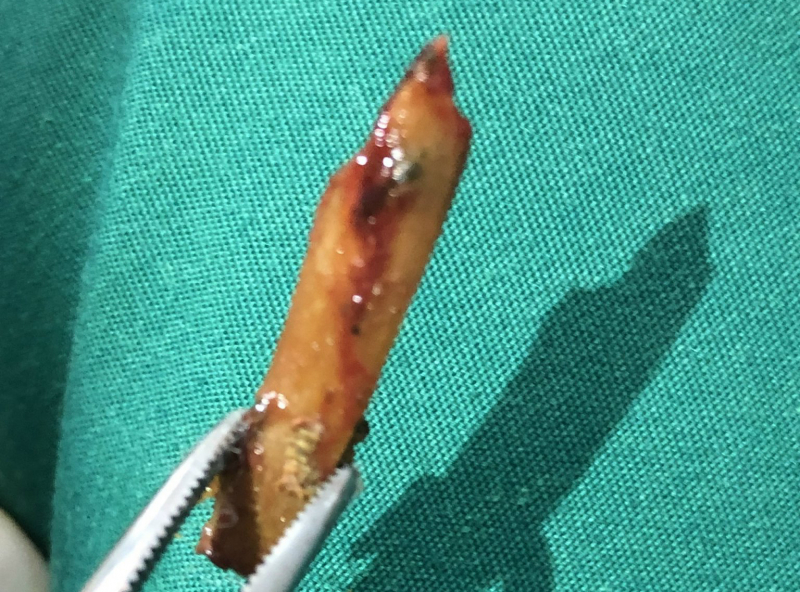 Người đàn ông bị xương gà đâm thủng hậu môn  -0