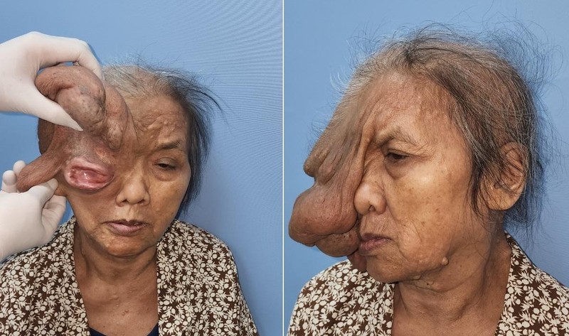 Thủ tướng gửi thư khen Bệnh viện phẫu thuật thành công khối u lớn cho cụ bà 73 tuổi -0