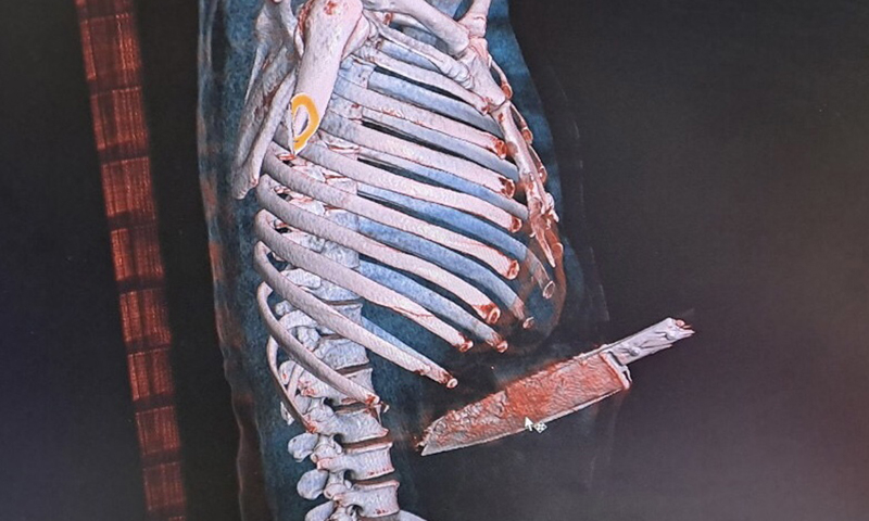 Mẫu thuẫn cá nhân dùng dao đâm thủng bụng bạn nhậu  -0