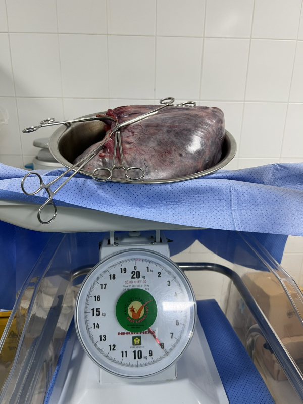 Phẫu thuật thành công bóc trọn khối u nang buồng trứng 8kg -0