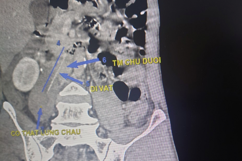 Ngậm tăm đi ngủ, người đàn ông bị thủng ruột non -0