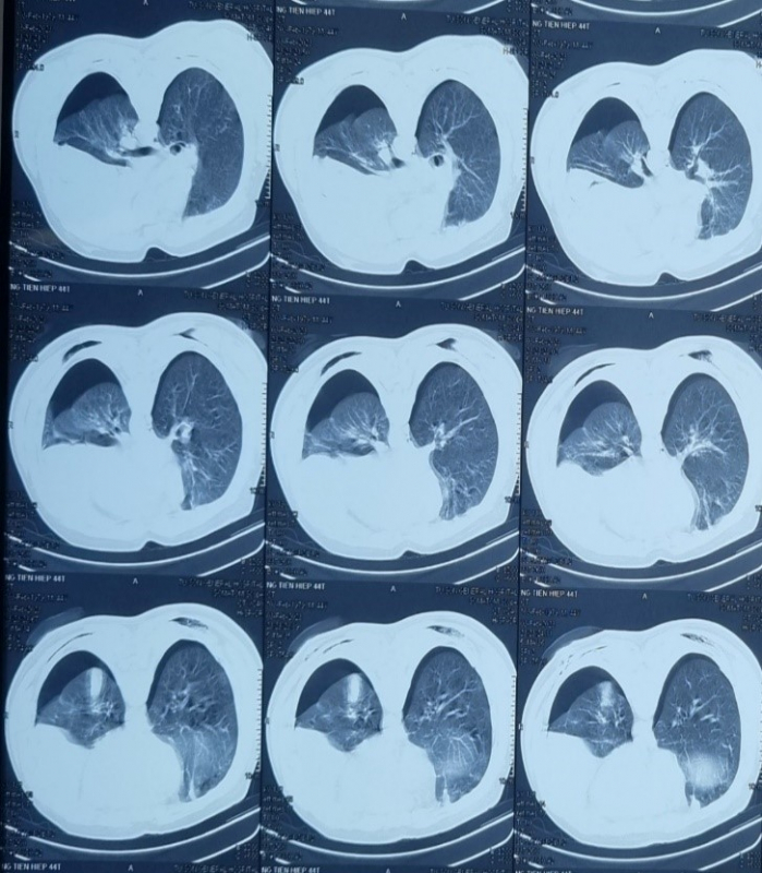 Cứu sống người bán hàng bị 3 vết thương đâm thấu ngực -0