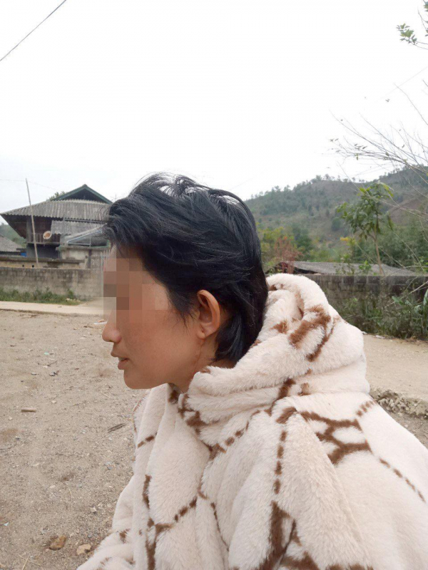 Nối lại toàn bộ da đầu, hai tai, mí mắt bị đứt rời cho nữ công nhân -0