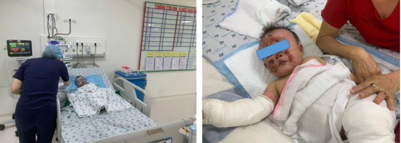 Người nhà bất cẩn thận, 2 trẻ bị phỏng cồn và nước sôi nghiêm trọng -0