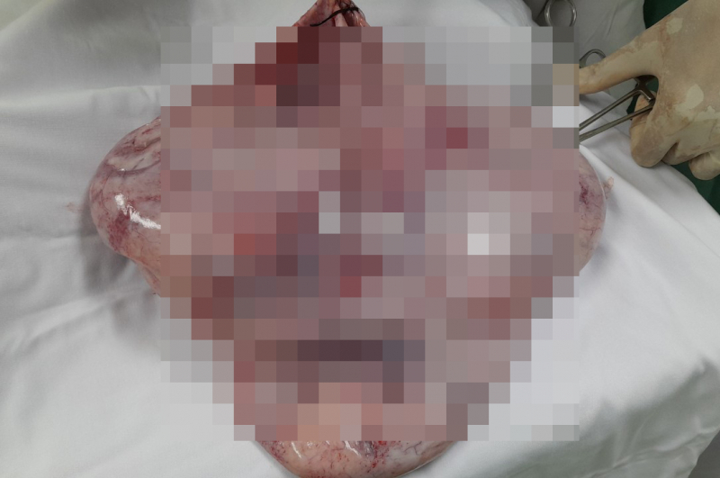 Lấy khối u nang khủng ra khỏi người thiếu nữ 19 tuổi ở Sóc Trăng -0