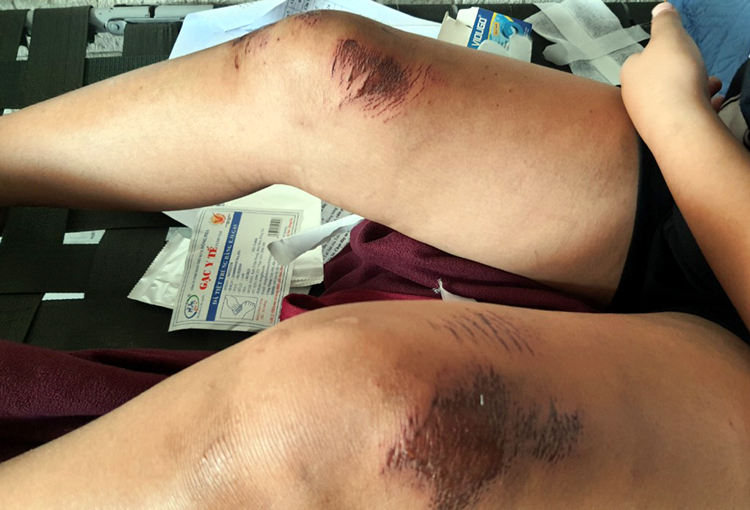 Bắt đối tượng trộm điện thoại kéo lê bé gái 13 tuổi -0
