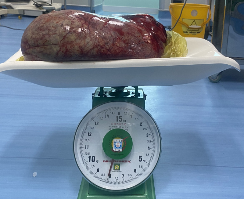 Phẫu thuật lấy khối u buồng trứng nặng 8.1 kg cho cụ bà 83 tuổi  -1