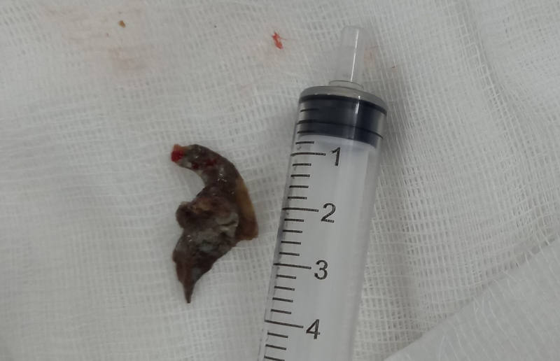 Lấy xương cá nằm 4 tuần trong phổi nam bệnh nhân -0