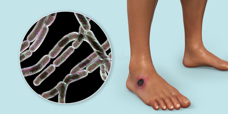 Việt Nam phát hiện 13 người mắc bệnh than, Bộ Y tế chỉ đạo khẩn -0