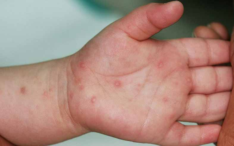 Bộ Y tế yêu cầu tăng cường theo dõi người bệnh tay chân miệng -0