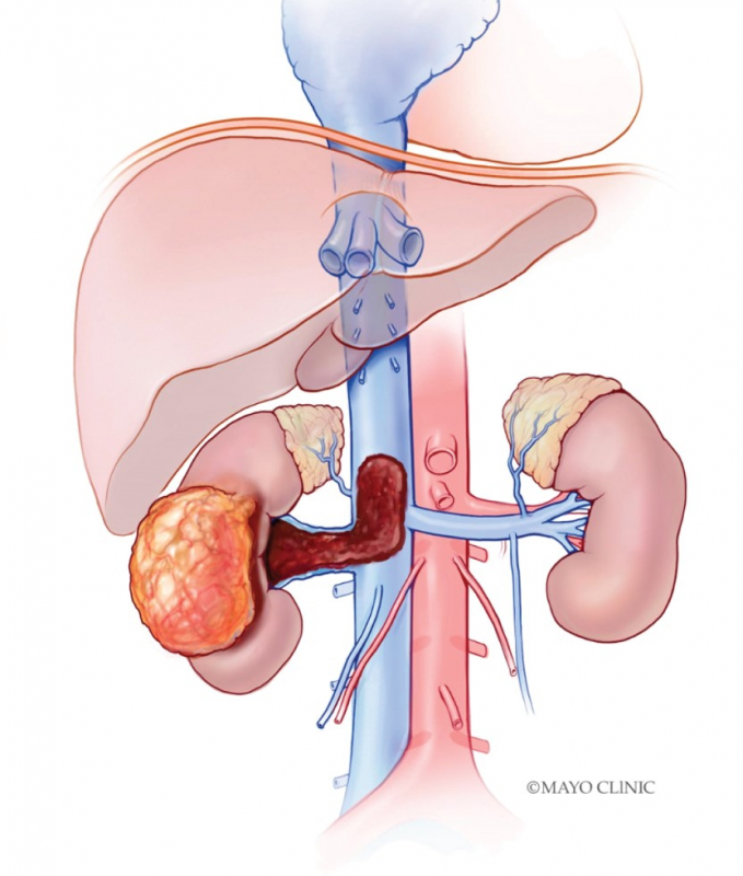 Lần đầu tiên phẫu thuật nội soi cho bệnh nhân ung thư thận có chồi bướu trong tĩnh mạch chủ  -0