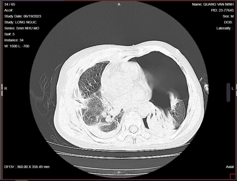 Cứu sống 2 ông cháu bị trâu húc -0