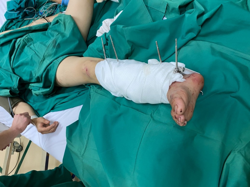 Nối thành công bàn chân gần đứt lìa cho bệnh nhân bị tai nạn giao thông -0