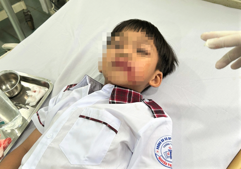 Chó lạ thả rông bất ngờ tấn công học sinh khiến một học sinh bị cắn rách mặt -0