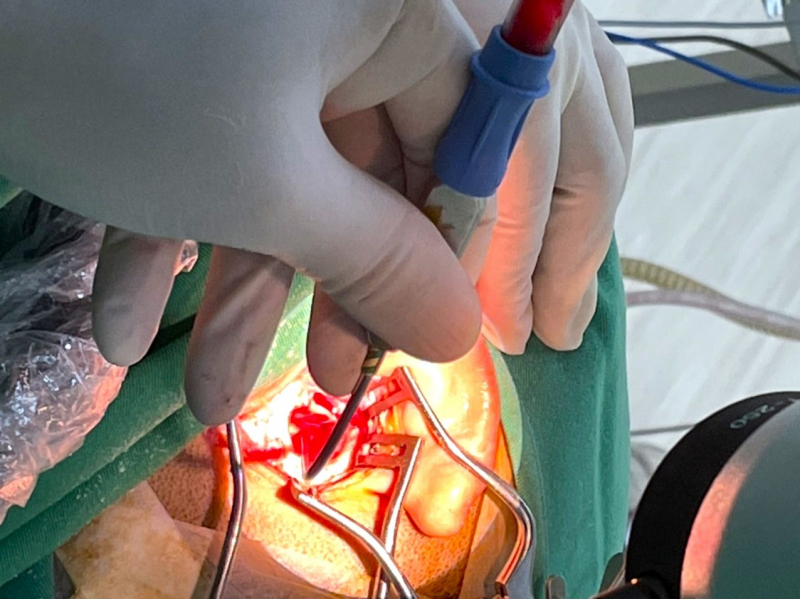 Bệnh viện 199  phẫu thuật mở xương chũm khó cho bệnh nhân người nước ngoài -0