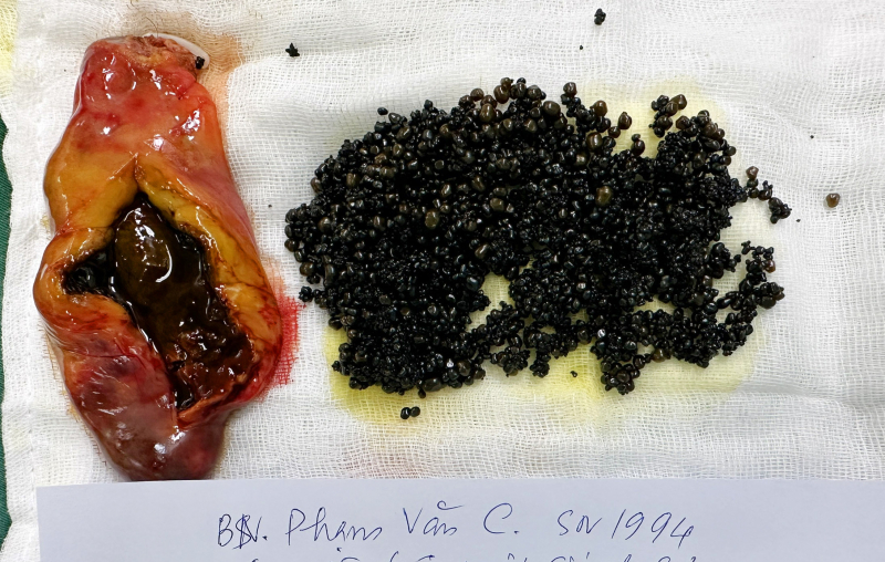 Bệnh nhân từ Nhật Bản về Việt Nam cắt túi mật có hơn 3.200 viên sỏi -0